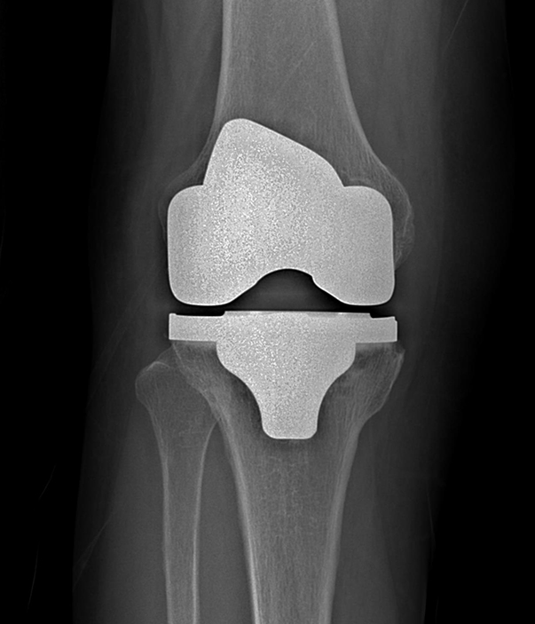 무릎인공관절치환술