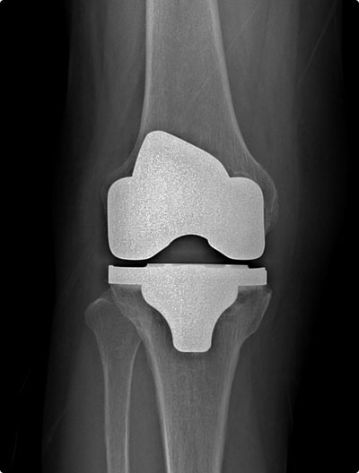무릎인공관절치환술 시행